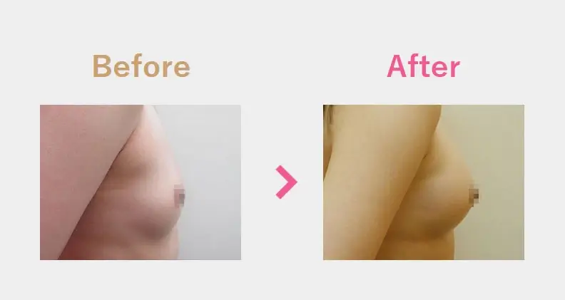 Before After（横）