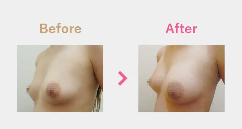 Before After（横）