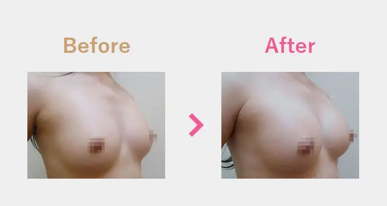 Before After（横）