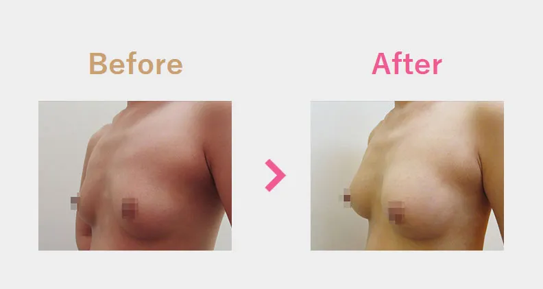 Before After（横）
