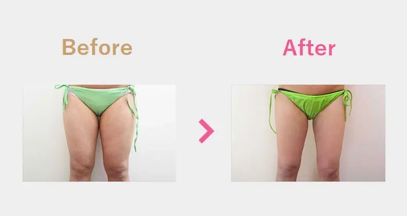 Before After（後）
