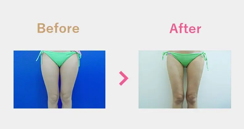 Before After（正面）