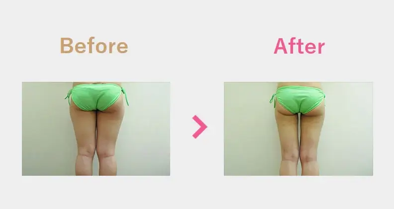 Before After（後）
