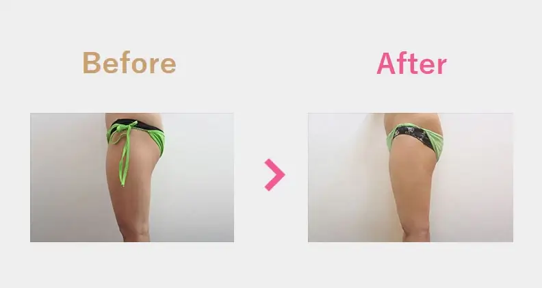 Before After（横）