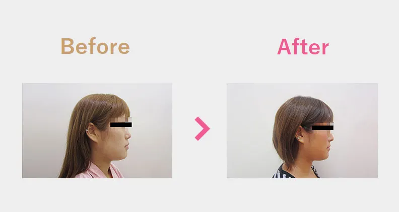 Before After（横）