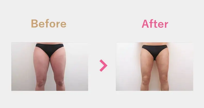 Before After（正面）