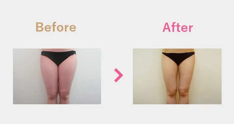 Before After（横）