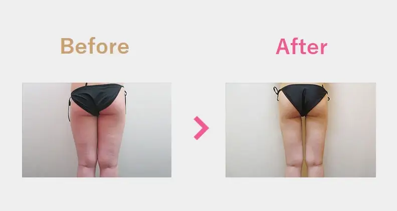 Before After（後）