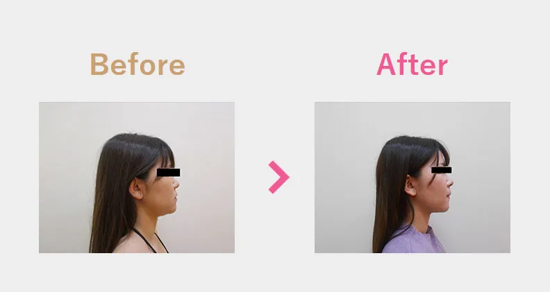 Before After（横）