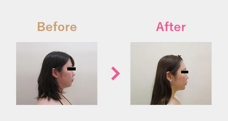 Before After（横）