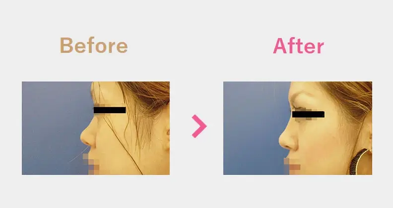 Before After（横）