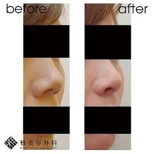 Before After（斜め）