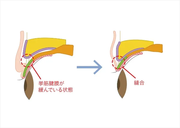手術手順