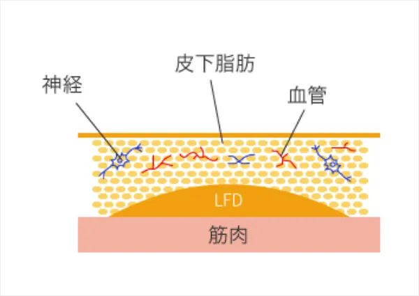 深い層にある皮下脂肪「LFD」