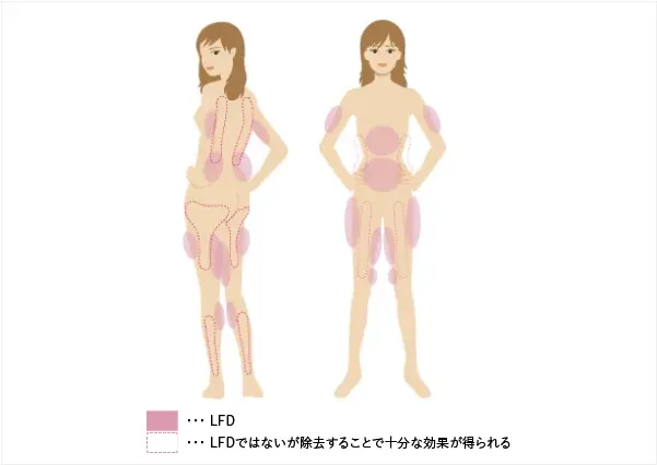 脂肪吸引で効果を得られる部位