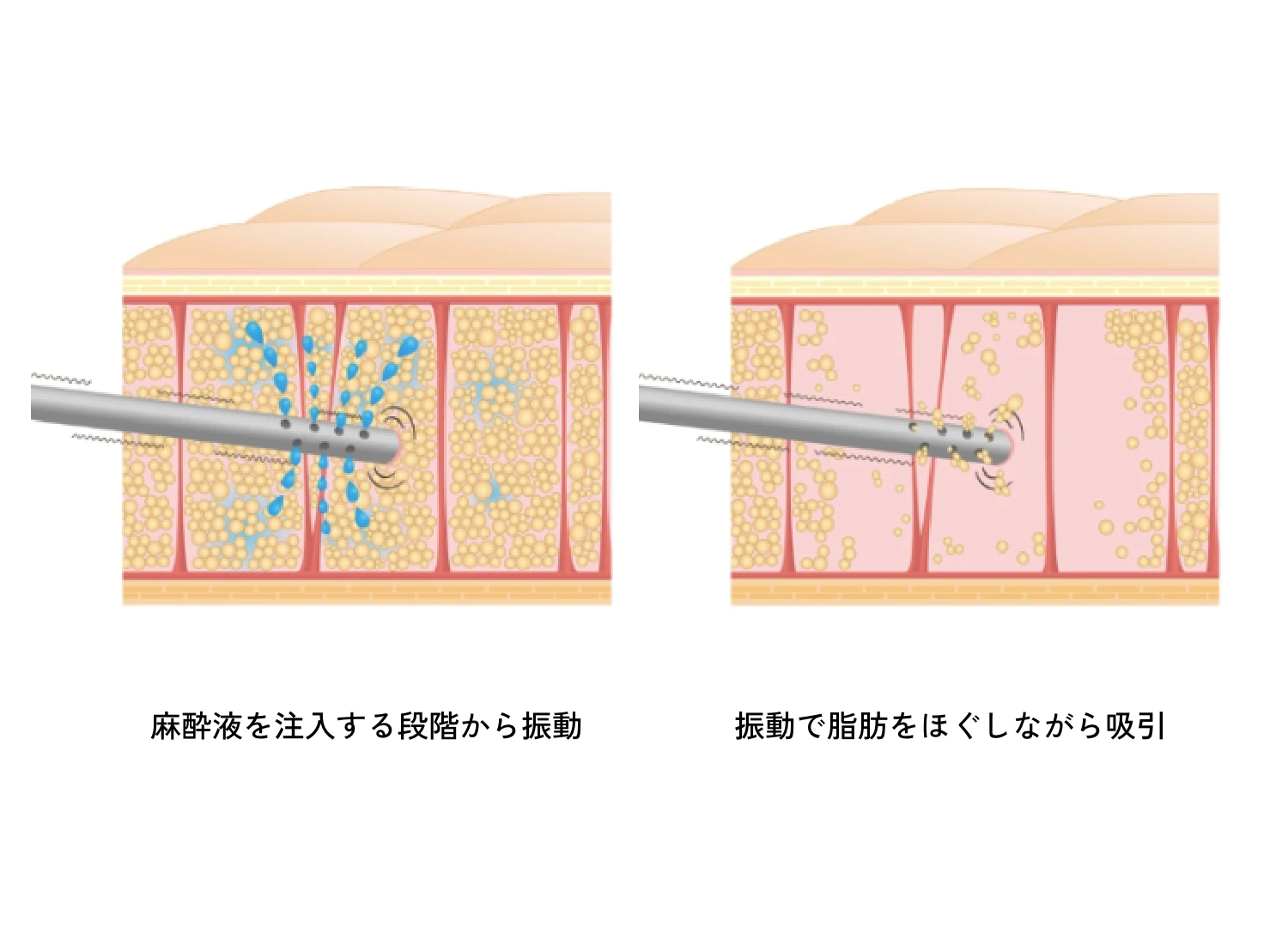 振動でほぐして注入に適した脂肪を吸引