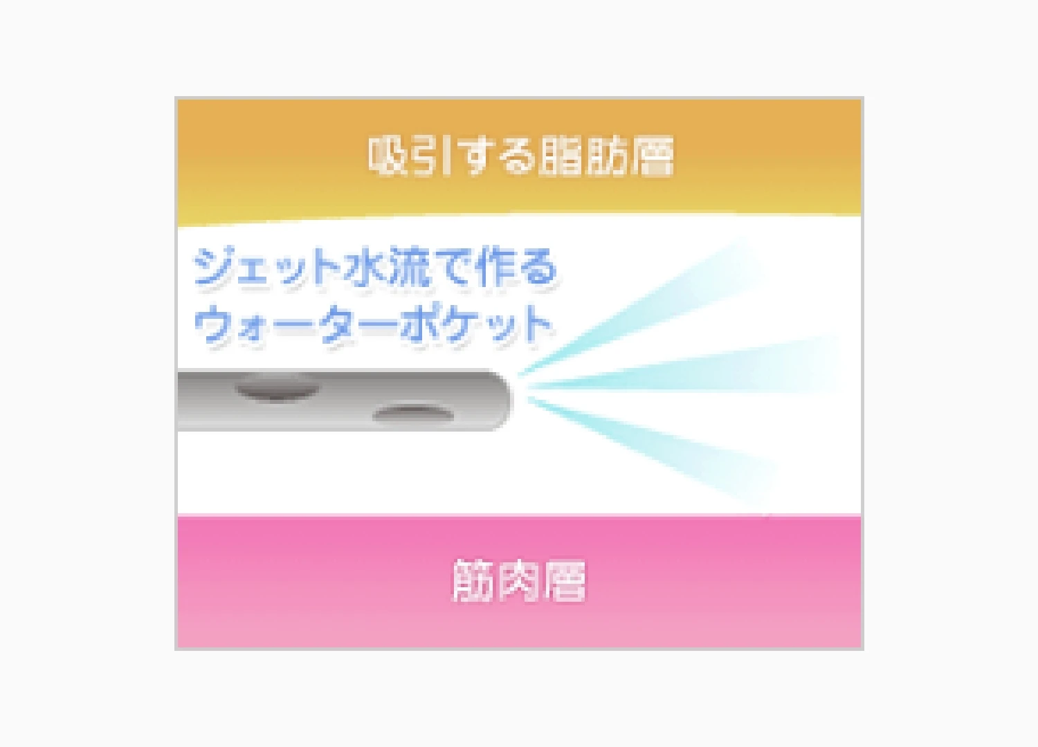 ウォータージェット脂肪吸引