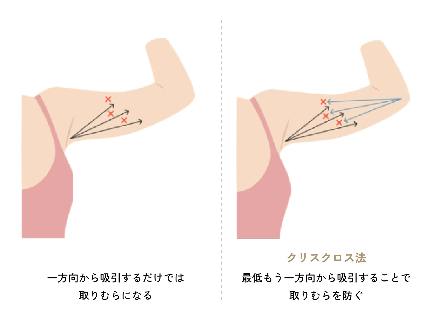 脂肪吸引は大阪雅美容外科へ。おすすめクリニックと紹介される理由。