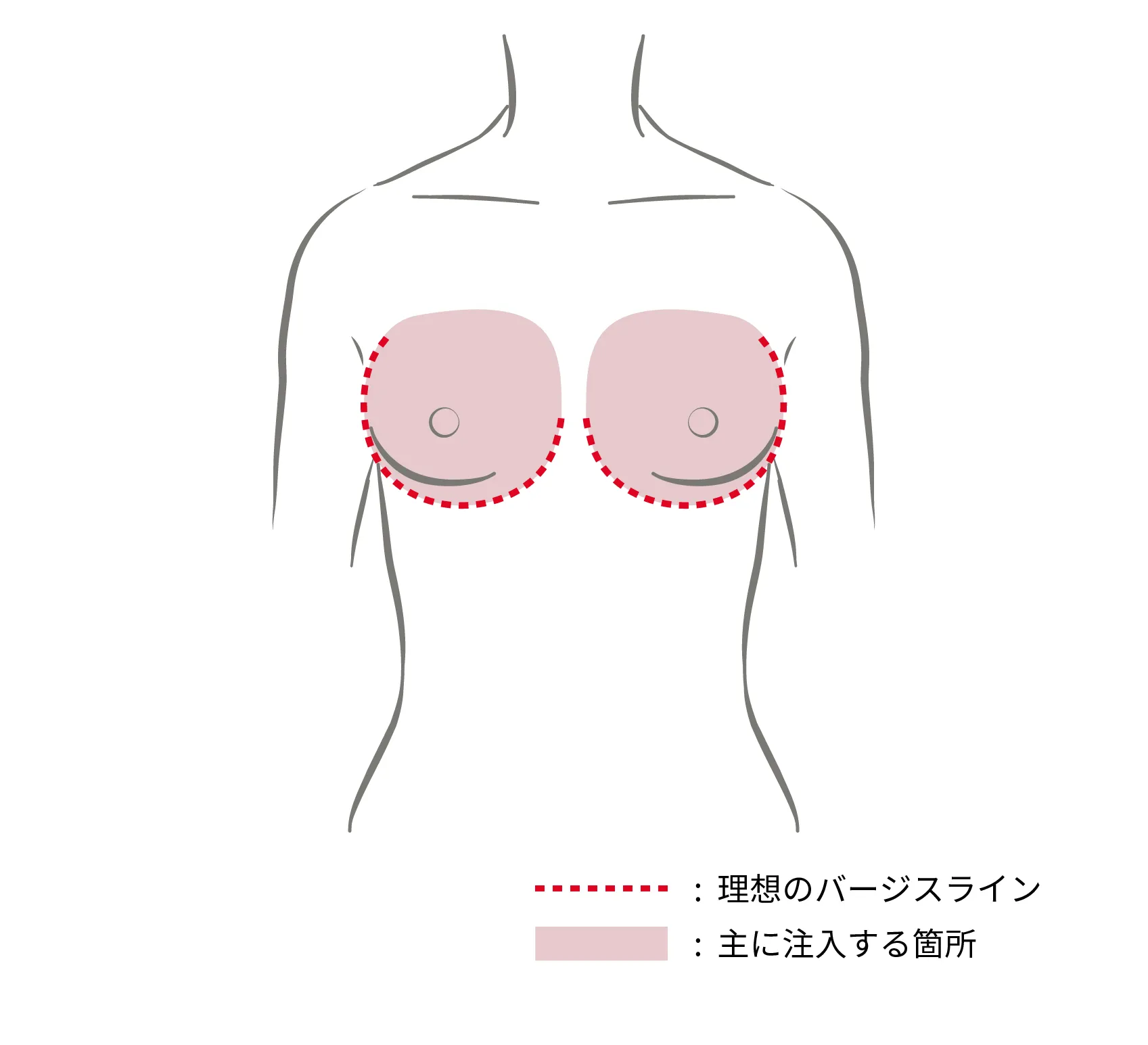 痩せ型タイプ（注入ポイント）