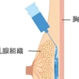 ヒアルロン酸豊胸