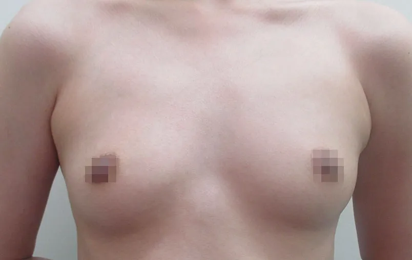 脂肪吸入豊胸の症例写真一覧