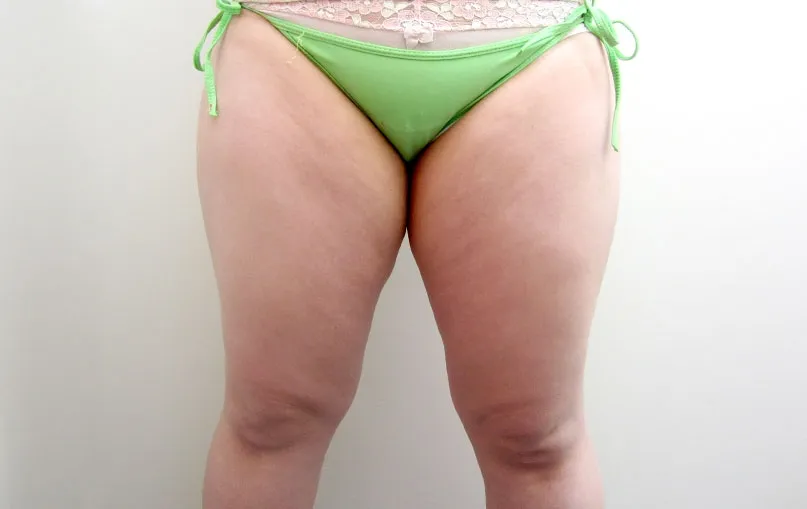 脂肪吸引の症例写真一覧