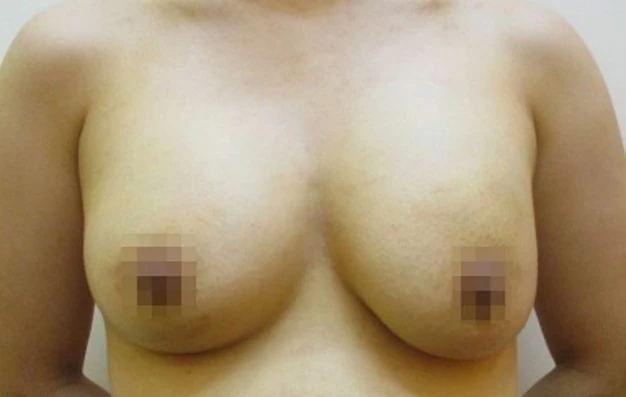 脂肪吸入豊胸の症例写真一覧