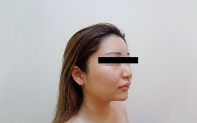 脂肪吸引の症例写真一覧