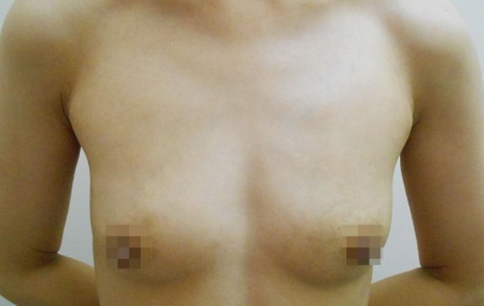 豊胸術の症例写真一覧