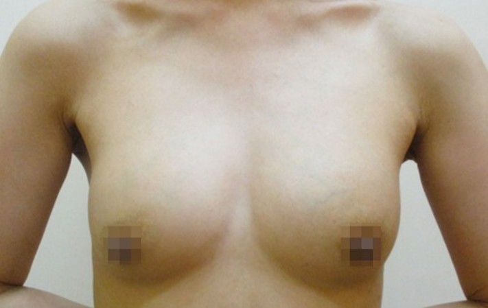 豊胸術の症例写真一覧
