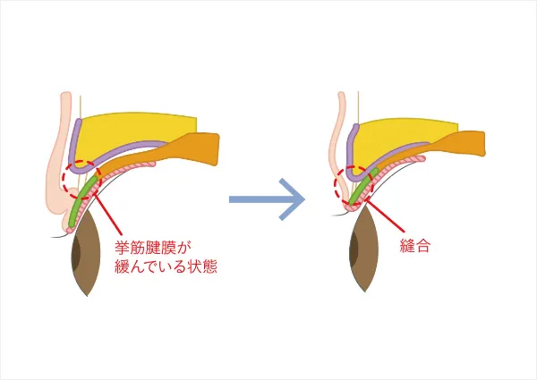まぶたの重さを解消する眼瞼下垂手術