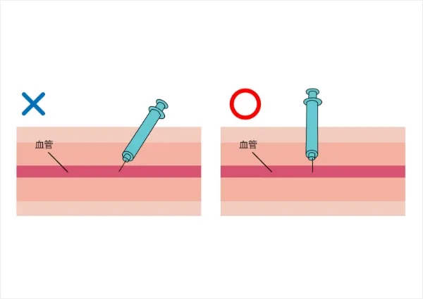 リスクを抑える注入方法