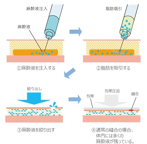 通常の脂肪吸引