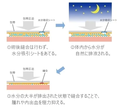 翌日縫合の場合
