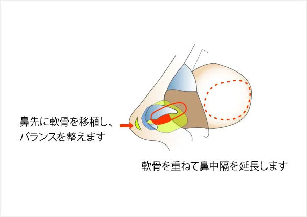 鼻中隔延長術について