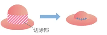 乳頭の高さを低くする場合