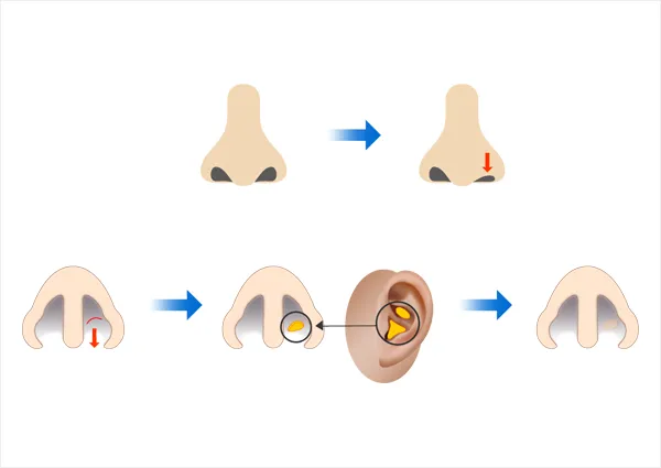 鼻孔縁形成術とは