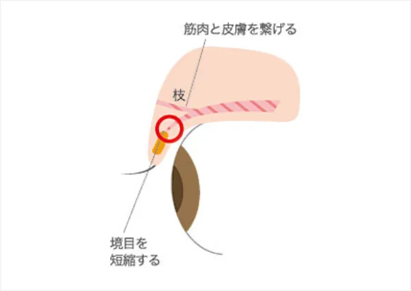 筋肉と皮膚を繋げる