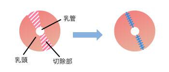 乳頭の直径（大きさ）を小さくする場合