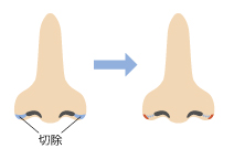 手術・傷跡について